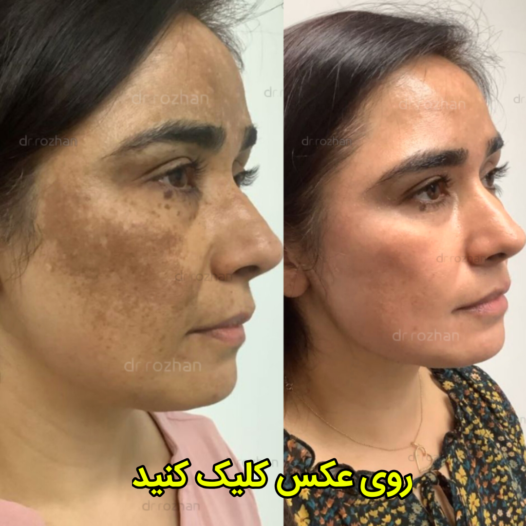 قبل و بعد از استفاده مشتری های عزیزمان 